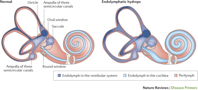Diagram showing a normal inner ear vs endolymphatic hydrops, which is associated with Meniere's disease. In the diagram, endolymph levels are illustrated in blue. The blue areas are much bigger in the diagram with endolymphatic hydrops.