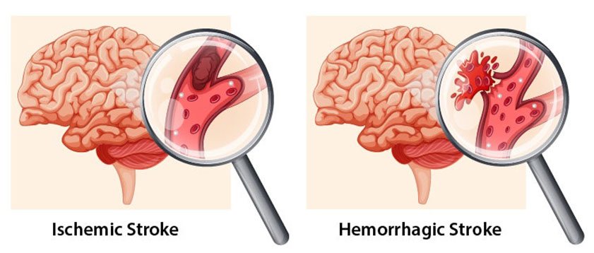 Diagram of ischemic stroke (caused by a blood vessel blockage) and haemorrhagic stroke (caused by a ruptured blood vessel)