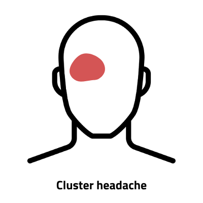 Diagram of cluster headache pain, located behind the eye