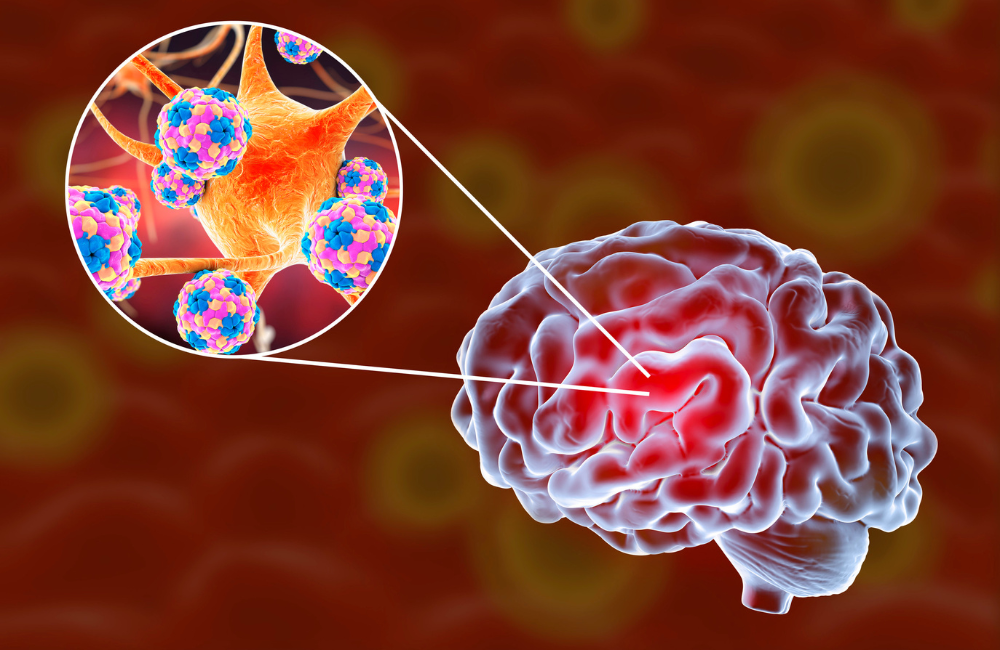 Generic diagram showing inflammation in the brain due to meningitis infection