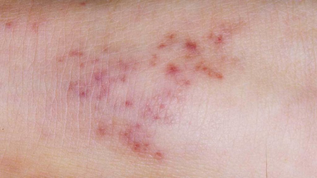 Photo of rash caused by meningitis