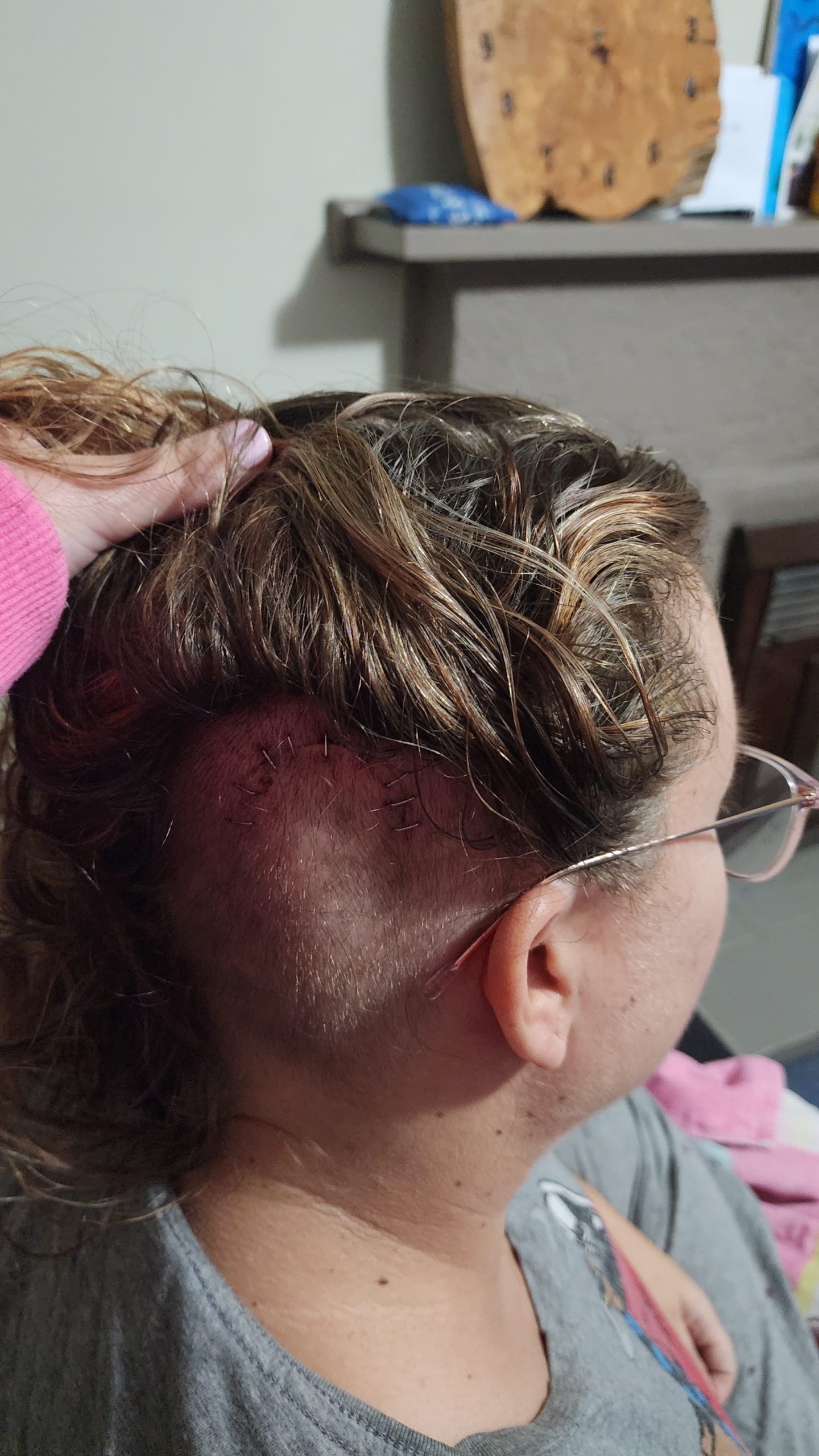 An image of Hayley's head. Her hair is pulled back to show the stitches from surgery when they inserted the VP shunt.
